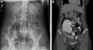 Is it normal to have abdominal pain 2 weeks after a colonoscopy? [2025] | QAQooking.wiki