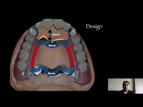 The Anteroposterior Palatal Strap major connector