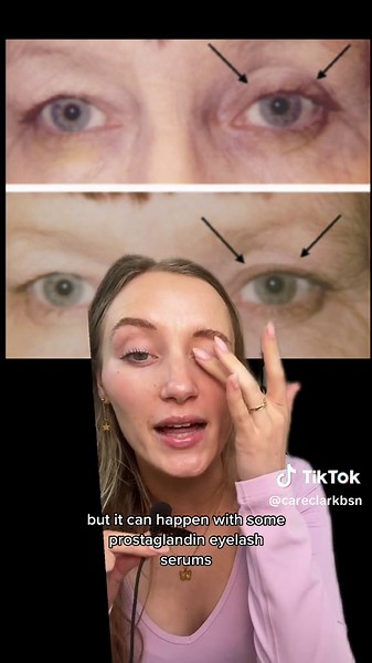 Examples of Periorbital Fat Loss from Lash Serums