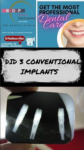 Step-by-Step Placement of Molar Conventional Dental Implants WITH OPG