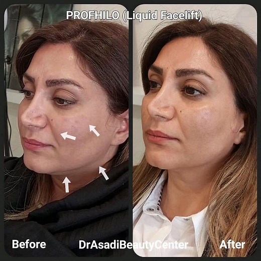 Non-Surgical Facelift, PROFHILO, before and after photos; Lift; Rejuvenation; Deep hydration #shorts