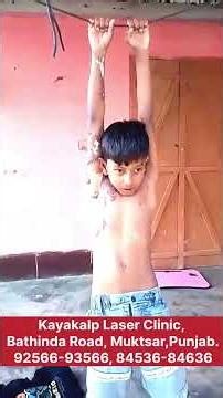 स्किन जलने के बाद भी मुस्कान क्यों?! Burn Scar Treatment Options