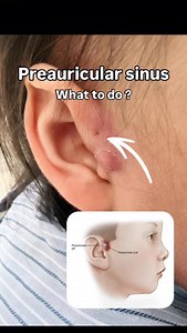 A small little hole 🕳️ called a preauricular pit can be seen at the front part of the ear in around 1-5% of children. What you don't see is a little sac hiding under the skin called a preauricular cyst. Sometimes bacteria 🦠or viruses can enter the cyst through the little hole and infection. The first sign of an infection would be redness and swelling around the pit. If this infection isn't treated early, it can lead to an abscess which often needs surgical intervention to drain the pus our. Fo