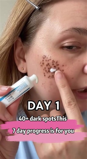 Transform Your Skin: The Ultimate TX Cream for Hyperpigmentation