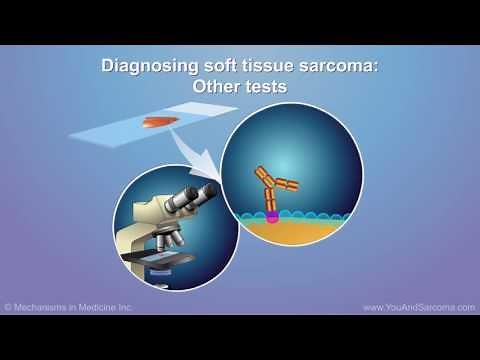 Diagnosing and Treating Soft Tissue Sarcoma
