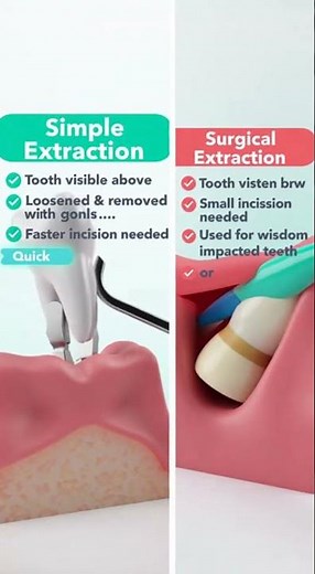 the words “surgical extraction” can sound intimidating.