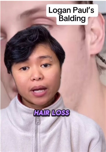 Logan Paul has been treating male pattern baldness and hair loss for many years now. His results prove that DHT Blockers and proactive treatment gets transformation results! Looks amazing. 📍HAMILTON, TORONTO ON, 🔗click the link in my bio and book with me!📆 #hairloss #balding #torontobarber #queerbarber #asianbarber