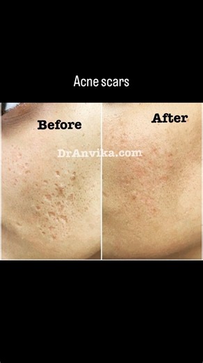Acne Scar Treatment | acne scar laser treatment | acne scar cream | how to remove acne scars