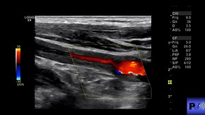 Takayasu Arteritis | John Z Wetmore