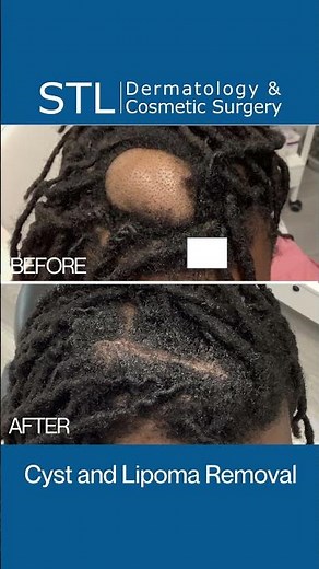 Scalp Cyst Removal | STL Derm