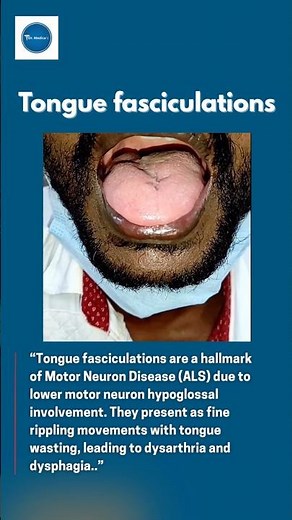 Tongue Fascinations || MND || #neurology #doctor #medicine #diagnosis ||