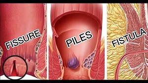 25 reactions · 5 comments | Piles, fissures, and fistulas are three...