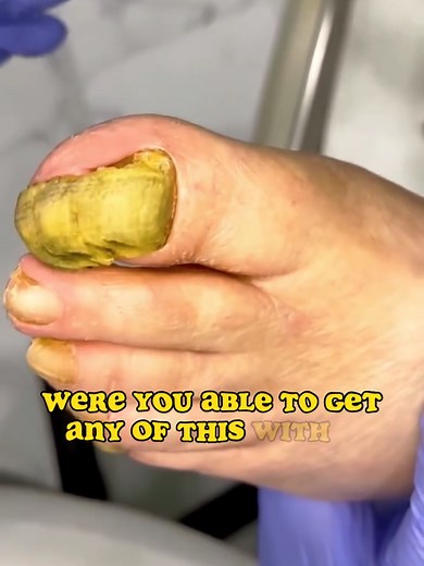 Full Toenail Removal Procedure and Technique Demo