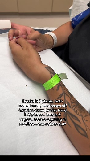 Dislocated ey'? Hmm..... 9 breaks later, step below fracturing my elbow, torn everything in elbow, torn rotator cuff, frozen shoulder, bicep tendonitis, breaks hand in 3 spots, breaks 3 fingers, both bones in arm.... my radial split down my arm like you're chopping a piece of wood 3/4 down my arm. But the EMT's said