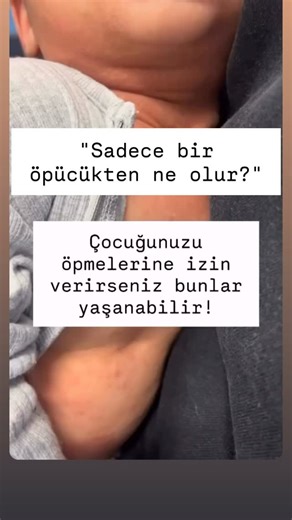 Deniz Ordu on Instagram: "⚠️ Bebeklerinizi Korumak İçin Lütfen Okuyun! Görüntülerdeki bebek, RSV (Respiratuar Sinsityal Virüs) nedeniyle ağır bir tabloyla karşı karşıya. Birçok ebeveynin “Sadece bir öpücükten ne olur?” diye düşündüğü anlar, ne yazık ki bebeklerin haftalarca hastanede, cihazlara bağlı kalmasına neden olabiliyor. • Yetişkinler Taşıyıcı Olabilir: Bir yetişkin hiçbir hastalık belirtisi göstermese bile RSV taşıyor olabilir. Basit bir hapşırık veya bir öpücük virüsü bebeğe bulaştırmak