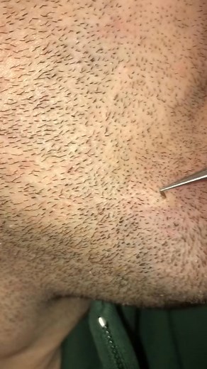 10K views · 26 reactions | Transform Your Look Instantly!  Watch Our Ultimate Mustache Removal Guide Using Tweezers for a Smooth Finish! ✨ #smoothlook #confidenceboost #selfcare #groomingtips #beautyhacks #skincareroutine #facialhair #mustacheremoval #mengrooming #beautyroutine #lookgoodfeelgood #mustachefree #personalcare #hairremoval #glowup #beautytips #selflove | April-09-04 | Facebook