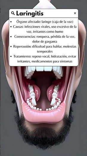 Laringitis #laringitis #laringe #enfermedad #inflamacion #medicina