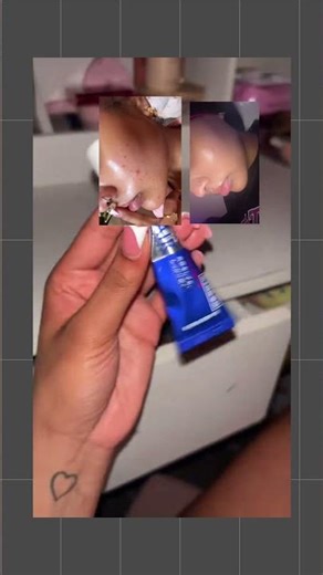 Found the cure link in bio for my random breakouts 😭