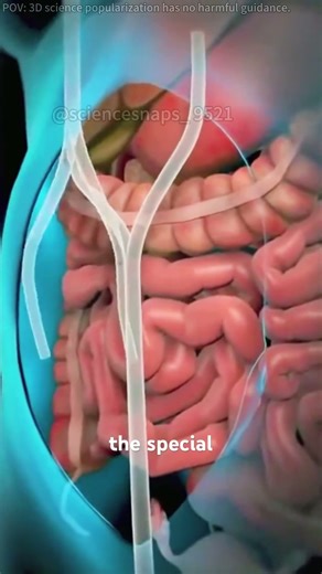 Hyperthermic intraperitoneal chemotherapy (HIPEC) #hipec #hipecchemotherapy #cancer #cancertreatment