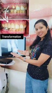 How did you put a cap on a broken tooth? | A doctor from Gujarat #trending #shorts #reels #viral ...