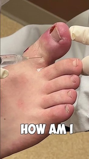 Dr. Nick's Incredible Numbing Technique for a Painful Big Toe!