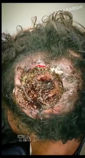 Guy got his head infested with maggots
