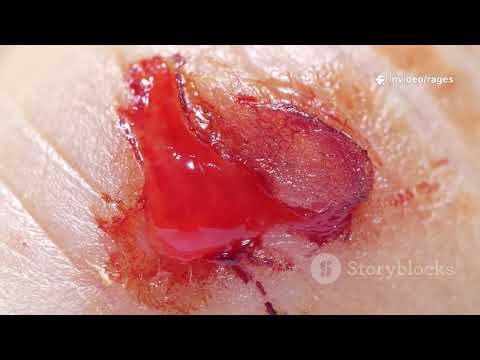 Wound Types Explained: From Cuts to Contusions!