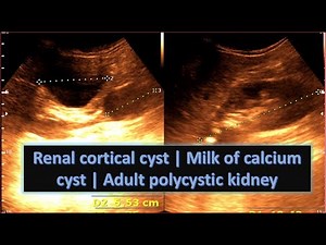 Renal cortical cyst | Milk of calcium cyst | Adult polycystic kidney