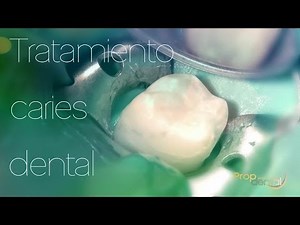 Tratamiento caries dental