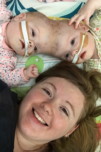 Conjoined twins Abby and Erin Delaney, who had only a 2% chance of survival at birth, recently reached an impressive milestone: both have graduated from kindergarten. Born prematurely at 30 weeks on July 24, 2016, they faced a very complex medical situation from the start. Their mother discovered at 11 weeks of pregnancy that her daughters were craniopagus, joined at the skull. This rare condition made the twins extremely vulnerable to serious complications. The girls shared a skull, skin, and a