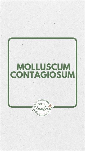 Well-Rooted Pediatrics on Instagram: "What You Need to Know: Molluscum contagiosum is a common (and typically harmless) viral skin infection in kids that shows up as small, skin-colored bumps—often with a little dimple in the center. It’s contagious, can spread through skin-to-skin contact or shared water (like pools and baths), and while it usually resolves on its own… that can take 9–12 months or longer. 😩 The good news? There are ways to support the body so it clears faster. ✔️ Strengthen th