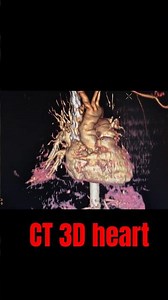 Ct Heart contrast scan #ct #ctscan #contrast #anatomy