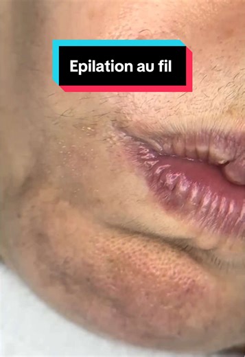 #epilationaufil
