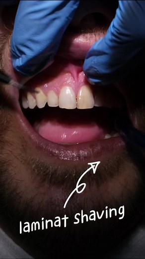 Laminate Shaving Process Shaving teeth for laminate veneers is a common dental procedure used to improve the appearance of a patient's smile. Laminate veneers are thin shells made of porcelain or composite resin that are bonded to the front surface of teeth to enhance their shape, size, and color. Before the veneers can be placed, the dentist will need to prepare the teeth by removing a small amount of enamel from the front surface. This is necessary to create enough space for the veneers to fit