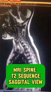Transverse myelitis MRI spine | Dr. Arshad Mehmood - Child Specialist