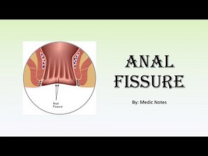 Anal fissure/pain in anal region? Signs and symptoms, treatment