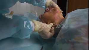 Aged woman doing mesothreads and Thread Lifting, Cosmetology. Cosmetic procedure to eliminate signs of aging. Beauty Face, Facial contour, plastic surgery concept for Age 70-80 years.