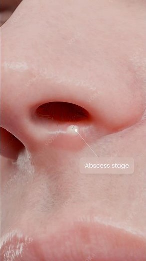 Nasal Furuncle: Acute Purulent Inflammation Explained in 3D