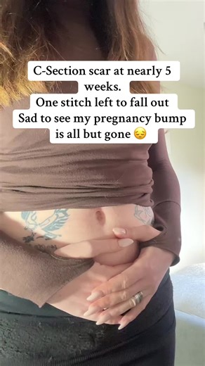 C-Section Scar Healing Progress at 5 Weeks