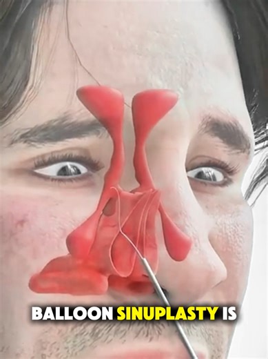 Understanding Balloon Sinoplasty: A 3D Animation Guide