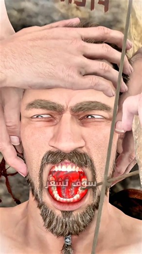 إزالة التسوس من الأسنان قديماً! 😱