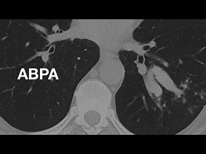 Classic Case: ABPA