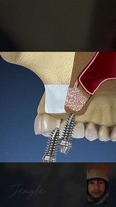 167 reactions · 5 comments | Sinus Lift Surgery | Jengle Maravilla Sabado | Facebook