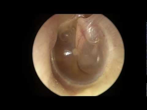 Serous Otitis Media