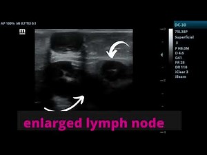 Ultrasound showing enlarged Inguinal Lymph Nodes