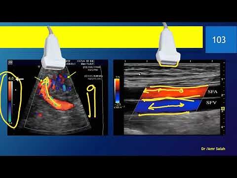 understanding Doppler ( color mode/ flow direction) DR/ AMR SALAH