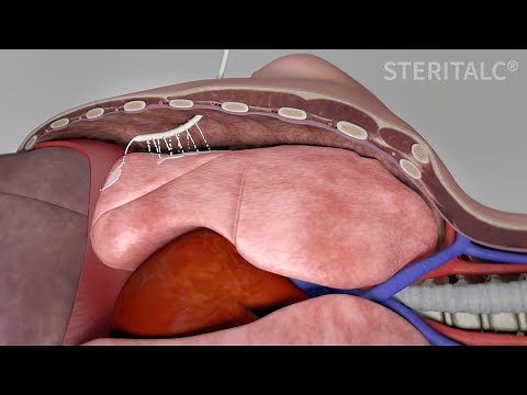 STERITALC® - poudrage vs slurry