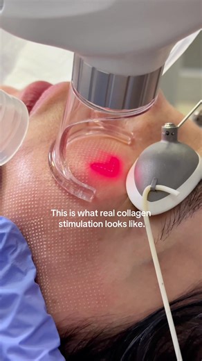 That visible pattern you’re seeing isn’t damage. It’s controlled fractional injury. CO2 laser creates controlled micro-channels in the skin that trigger natural collagen renewal.