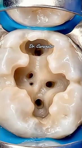 I found a SECRET Canal in this Tooth! 😱