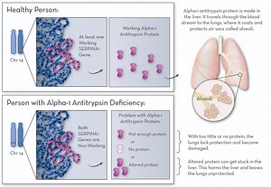 Alpha-1 Antitrypsin Deficiency